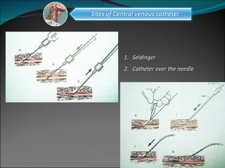 Seldinger  Catheter over the needle 