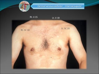 Rt. IJ 15 Rt. SC 18 Lt. IJ 18 Lt. SC 20 