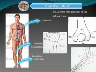 Humerus Distal tibia : malleolus 