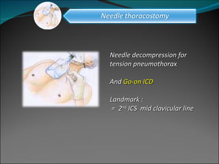 Needle decompression for tension pneumothorax  And  Go-on ICD Landmark :  =  2 nd  ICS  mid clavicular line 