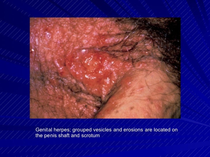 scrotal herpes #10