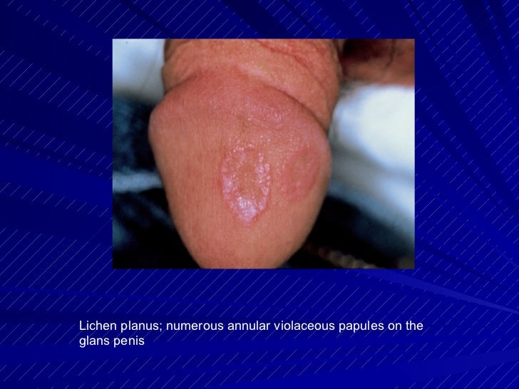 penile lesions pictures