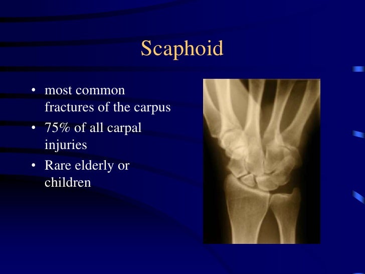 Common Upper Limb Fractures
