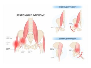 COMMON ACUTE AND OVERUSE INJURIES OF HIP JOINT.pptx