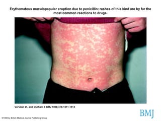 Erythematous maculopapular eruption due to penicillin: rashes of this kind are by far the
most common reactions to drugs.

Vervloet D , and Durham S BMJ 1998;316:1511-1514

©1998 by British Medical Journal Publishing Group

 