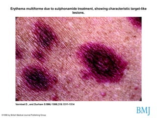 Erythema multiforme due to sulphonamide treatment, showing characteristic target-like
lesions.

Vervloet D , and Durham S BMJ 1998;316:1511-1514

©1998 by British Medical Journal Publishing Group

 