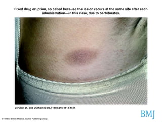 Fixed drug eruption, so called because the lesion recurs at the same site after each
administration—in this case, due to barbiturates.

Vervloet D , and Durham S BMJ 1998;316:1511-1514

©1998 by British Medical Journal Publishing Group

 