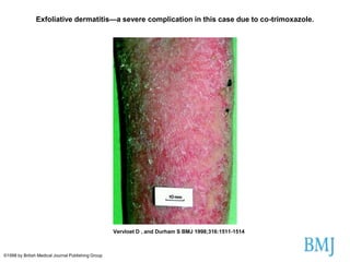 Exfoliative dermatitis—a severe complication in this case due to co-trimoxazole.

Vervloet D , and Durham S BMJ 1998;316:1511-1514

©1998 by British Medical Journal Publishing Group

 