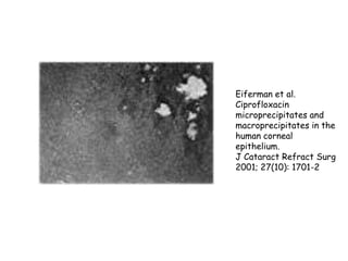 Eiferman et al.
Ciprofloxacin
microprecipitates and
macroprecipitates in the
human corneal
epithelium.
J Cataract Refract Surg
2001; 27(10): 1701-2

 