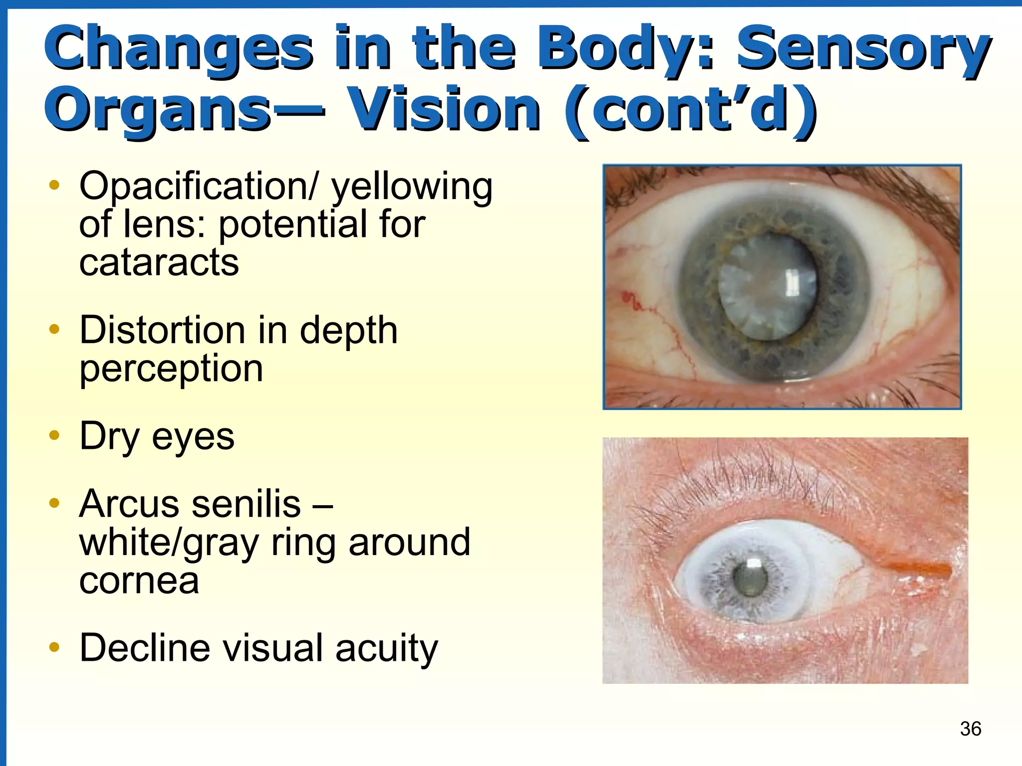 36
Changes in the Body: SensoryChanges in the Body: Sensory
Organs— Vision (cont’d)Organs— Vision (cont’d)
• Opacification/ yellowing
of lens: potential for
cataracts
• Distortion in depth
perception
• Dry eyes
• Arcus senilis –
white/gray ring around
cornea
• Decline visual acuity
 