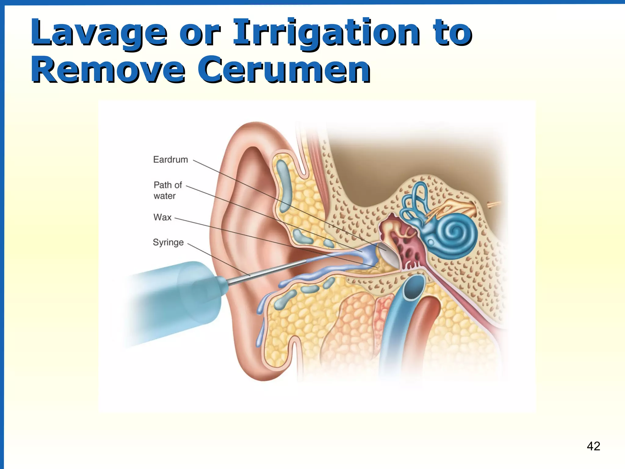42
Lavage or Irrigation toLavage or Irrigation to
Remove CerumenRemove Cerumen
 