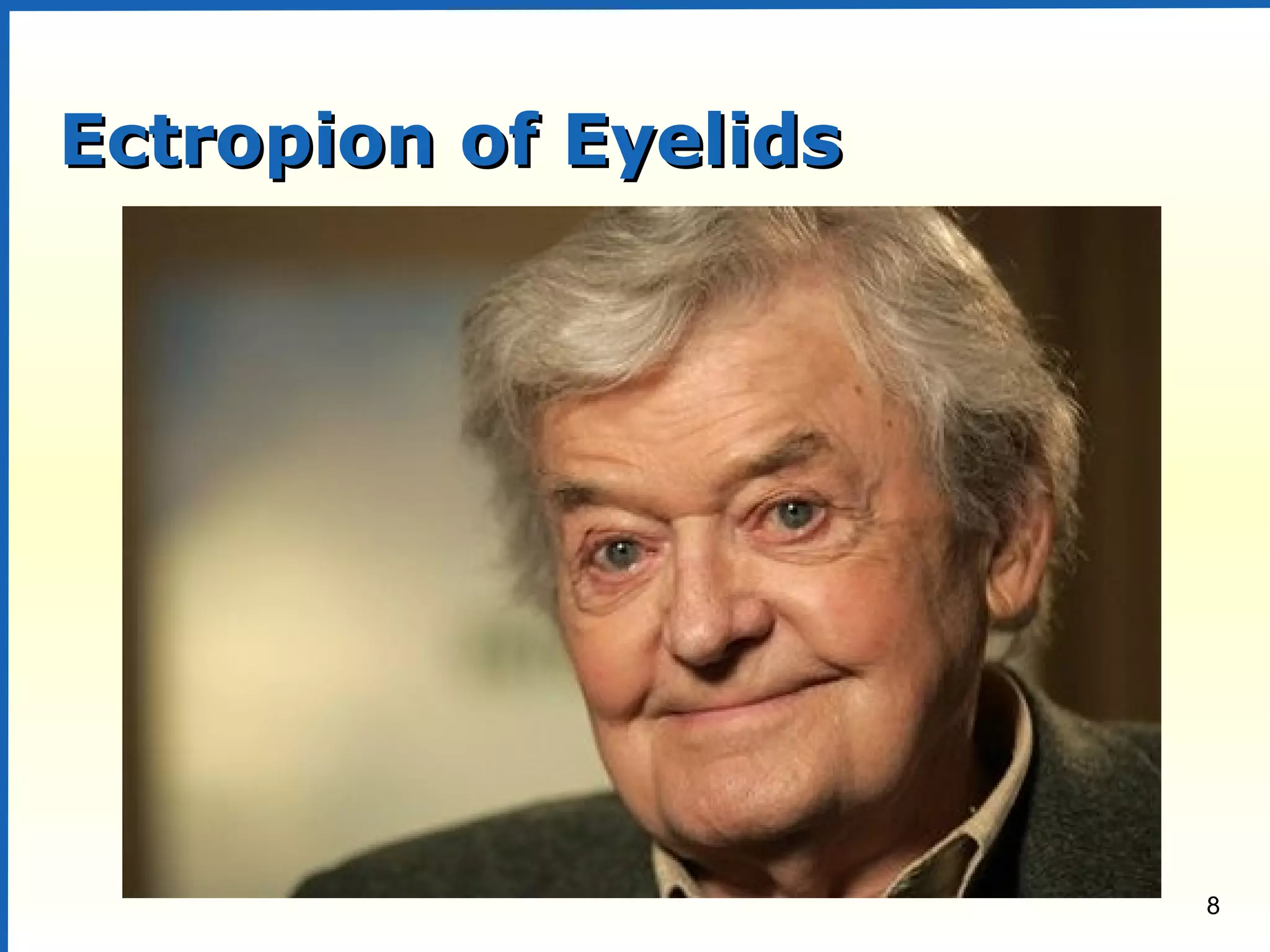 8
Ectropion of EyelidsEctropion of Eyelids
 