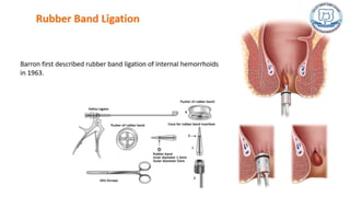 Common anal conditions.