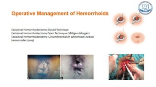 Common anal conditions.