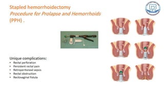 Common anal conditions.