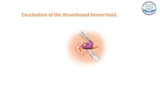 Common anal conditions.