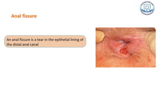 Common anal conditions.