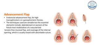 Common anal conditions.