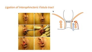 Common anal conditions.
