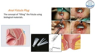 Common anal conditions.