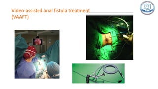 Common anal conditions.