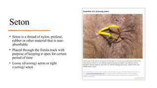 Common Anorectal Problems and its management.pptx