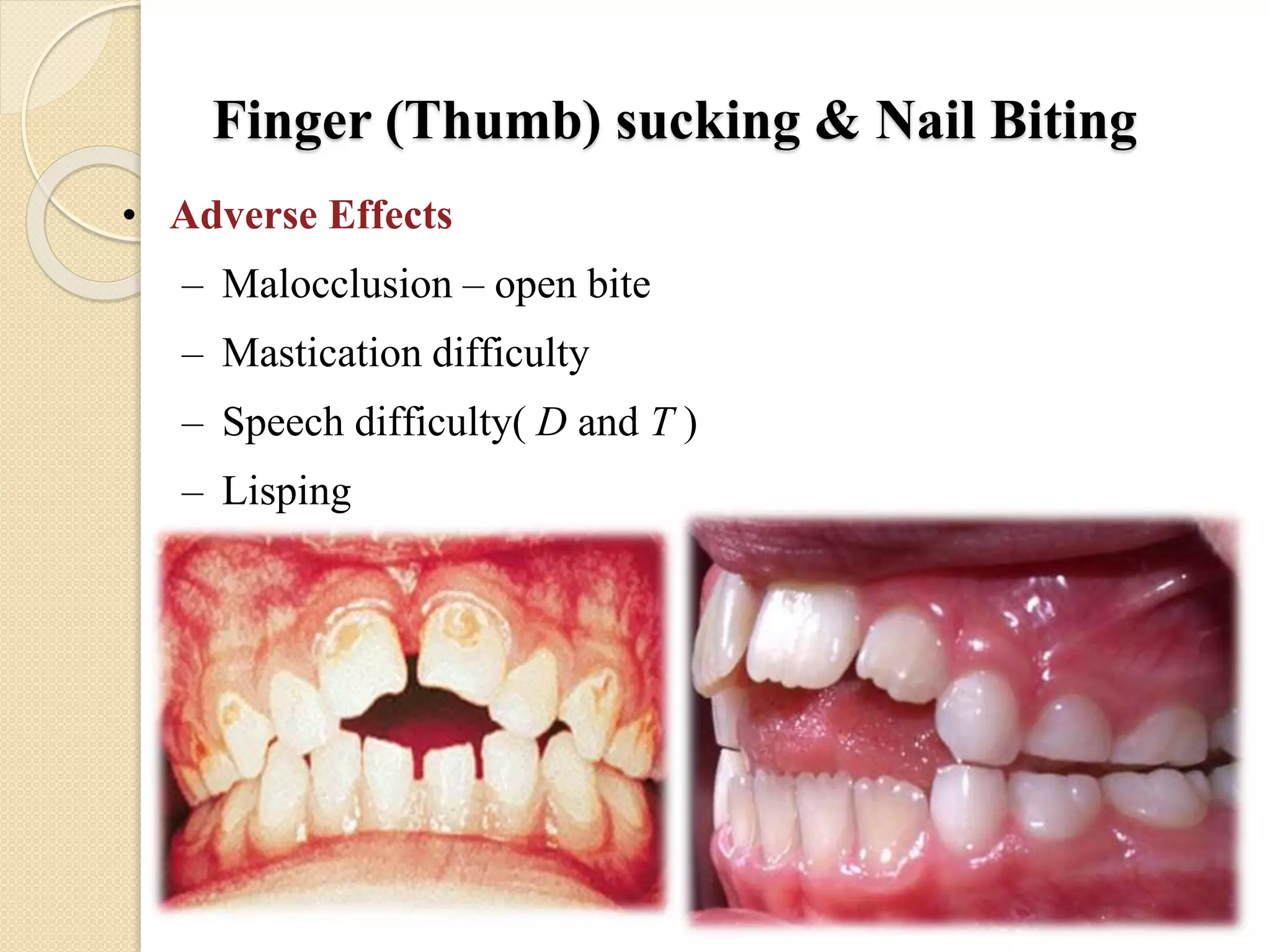 Finger (Thumb) sucking & Nail Biting
• Adverse Effects
– Malocclusion – open bite
– Mastication difficulty
– Speech difficulty( D and T )
– Lisping
 