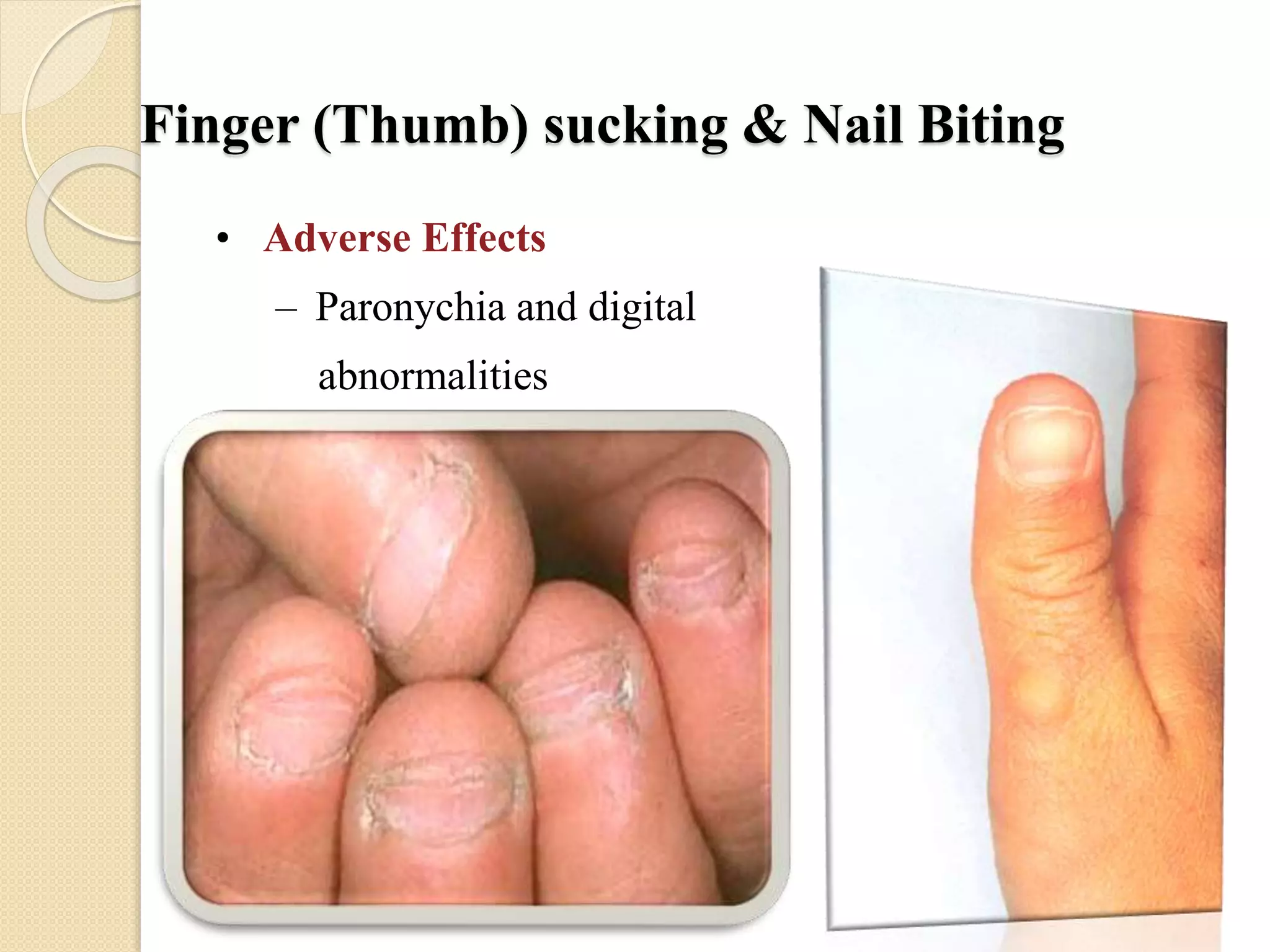 Finger (Thumb) sucking & Nail Biting
• Adverse Effects
– Paronychia and digital
abnormalities
 
