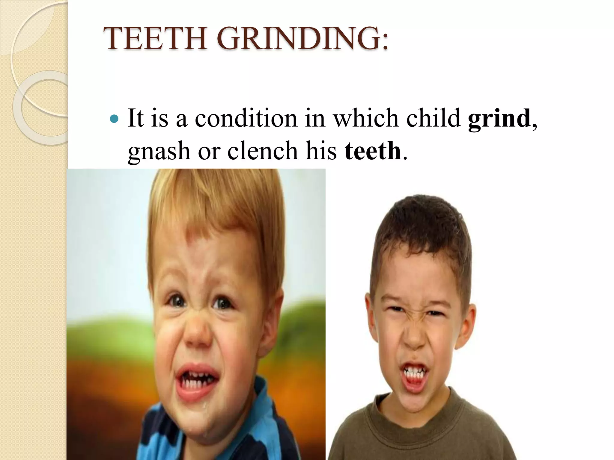 TEETH GRINDING:
 It is a condition in which child grind,
gnash or clench his teeth.
 