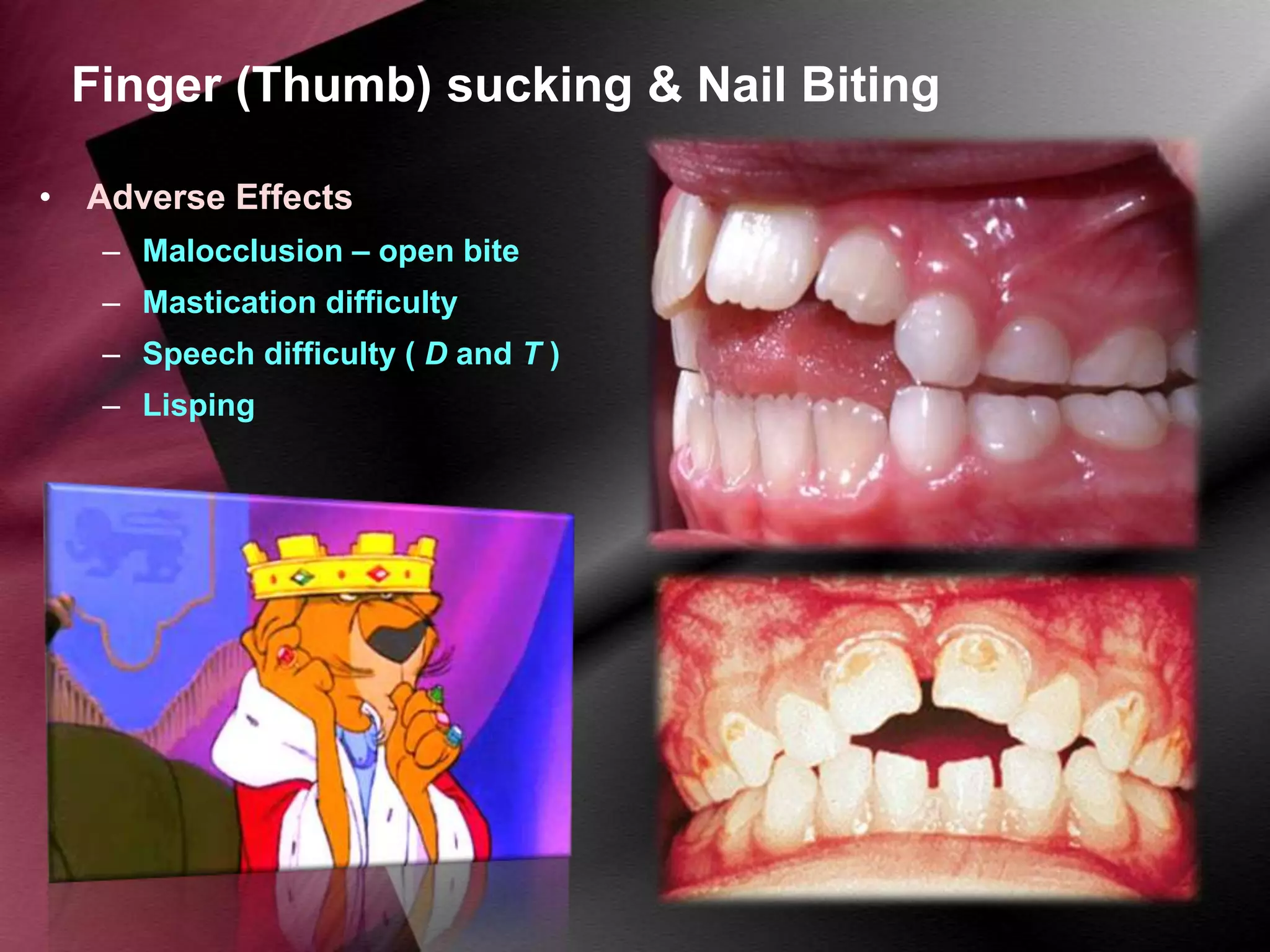Finger (Thumb) sucking & Nail Biting
• Adverse Effects
– Malocclusion – open bite

– Mastication difficulty
– Speech difficulty ( D and T )
– Lisping

 