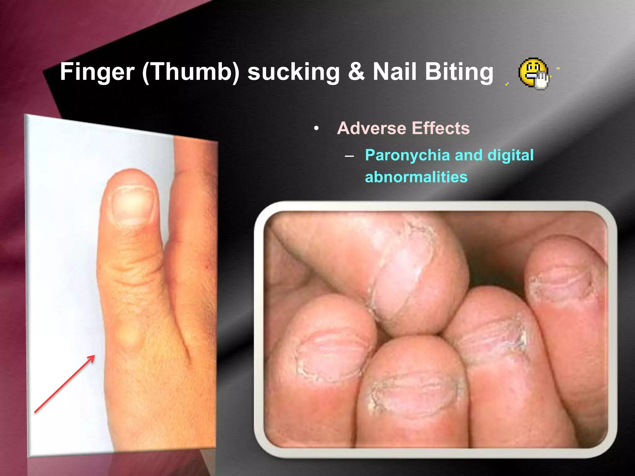 Finger (Thumb) sucking & Nail Biting
• Adverse Effects
– Paronychia and digital
abnormalities

 