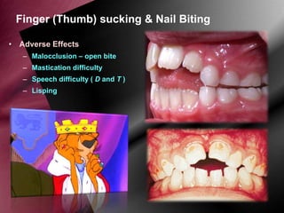Finger (Thumb) sucking & Nail Biting
• Adverse Effects
– Malocclusion – open bite

– Mastication difficulty
– Speech difficulty ( D and T )
– Lisping

 