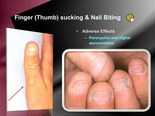 Finger (Thumb) sucking & Nail Biting
• Adverse Effects
– Paronychia and digital
abnormalities

 