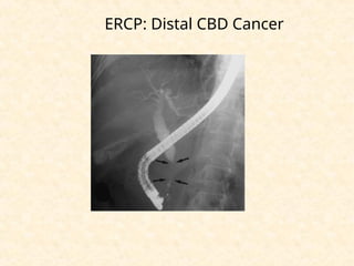 ERCP: Distal CBD Cancer
 