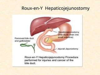 Roux-en-Y Hepaticojejunostomy
 