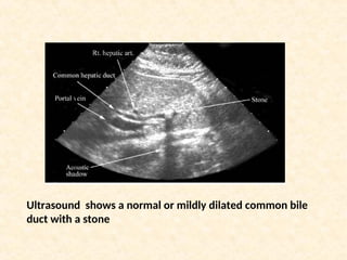 Ultrasound shows a normal or mildly dilated common bile
duct with a stone
 