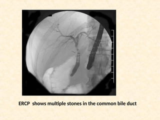 ERCP shows multiple stones in the common bile duct
 