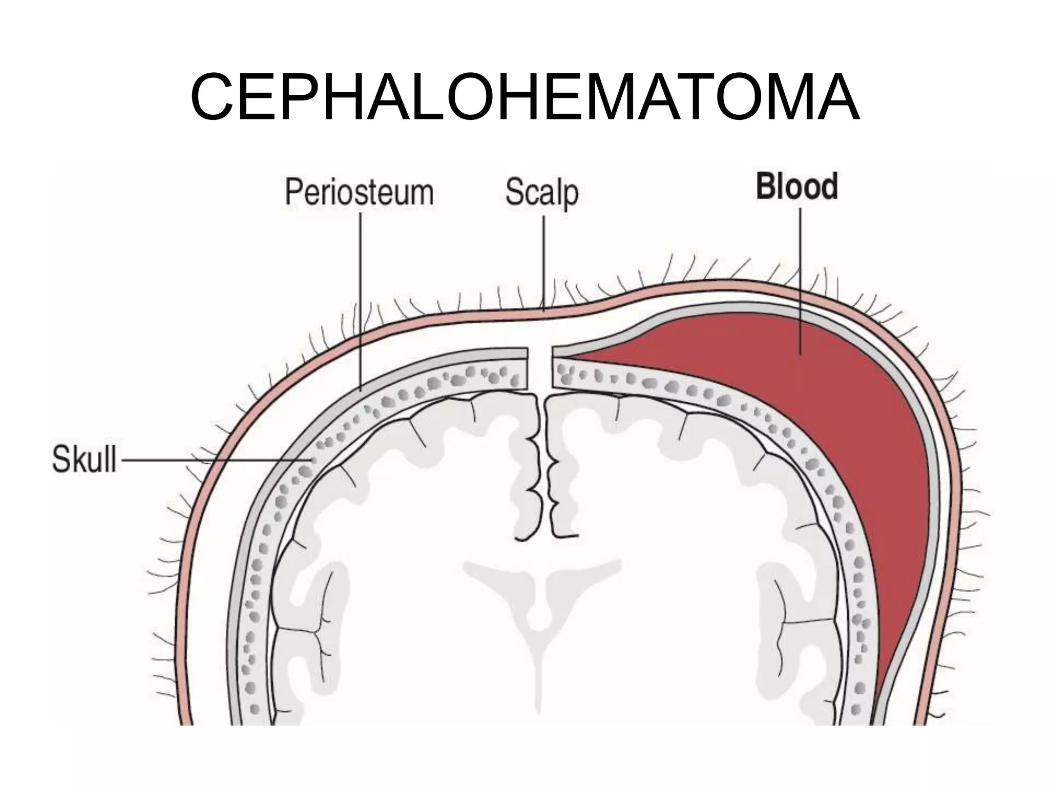 CEPHALOHEMATOMA
 