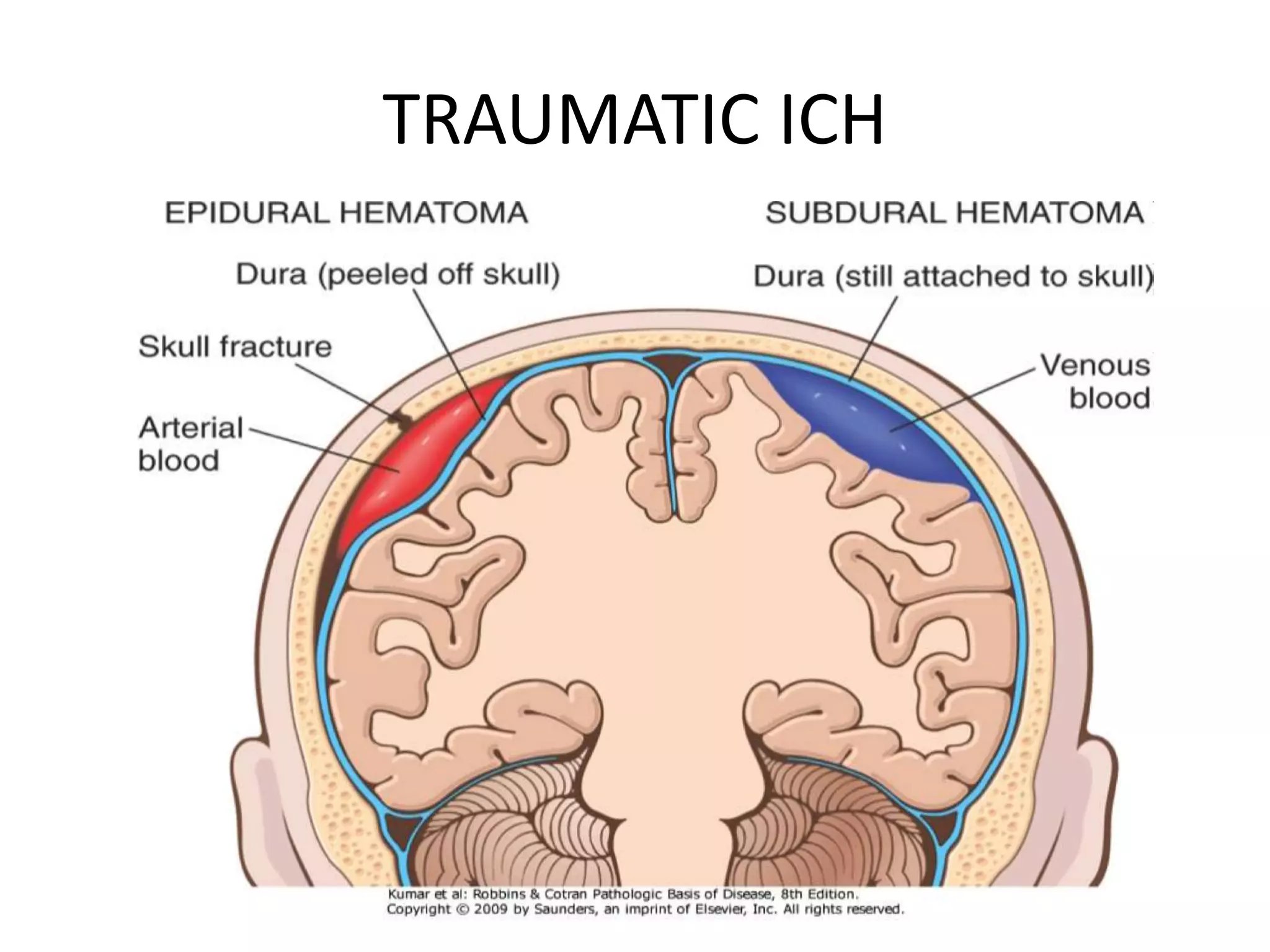 TRAUMATIC ICH
 