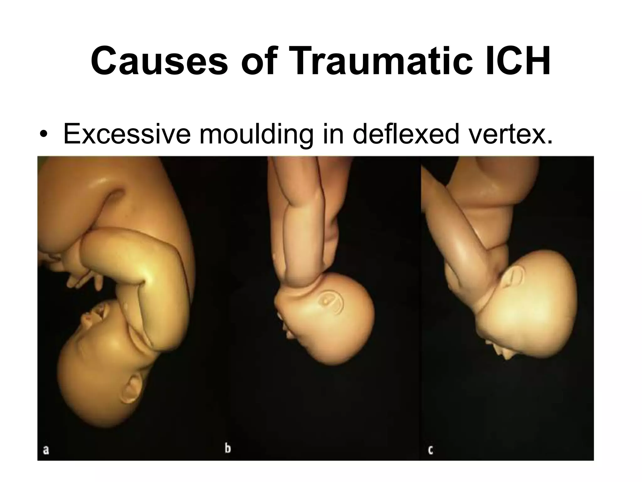 Causes of Traumatic ICH
• Excessive moulding in deflexed vertex.
 