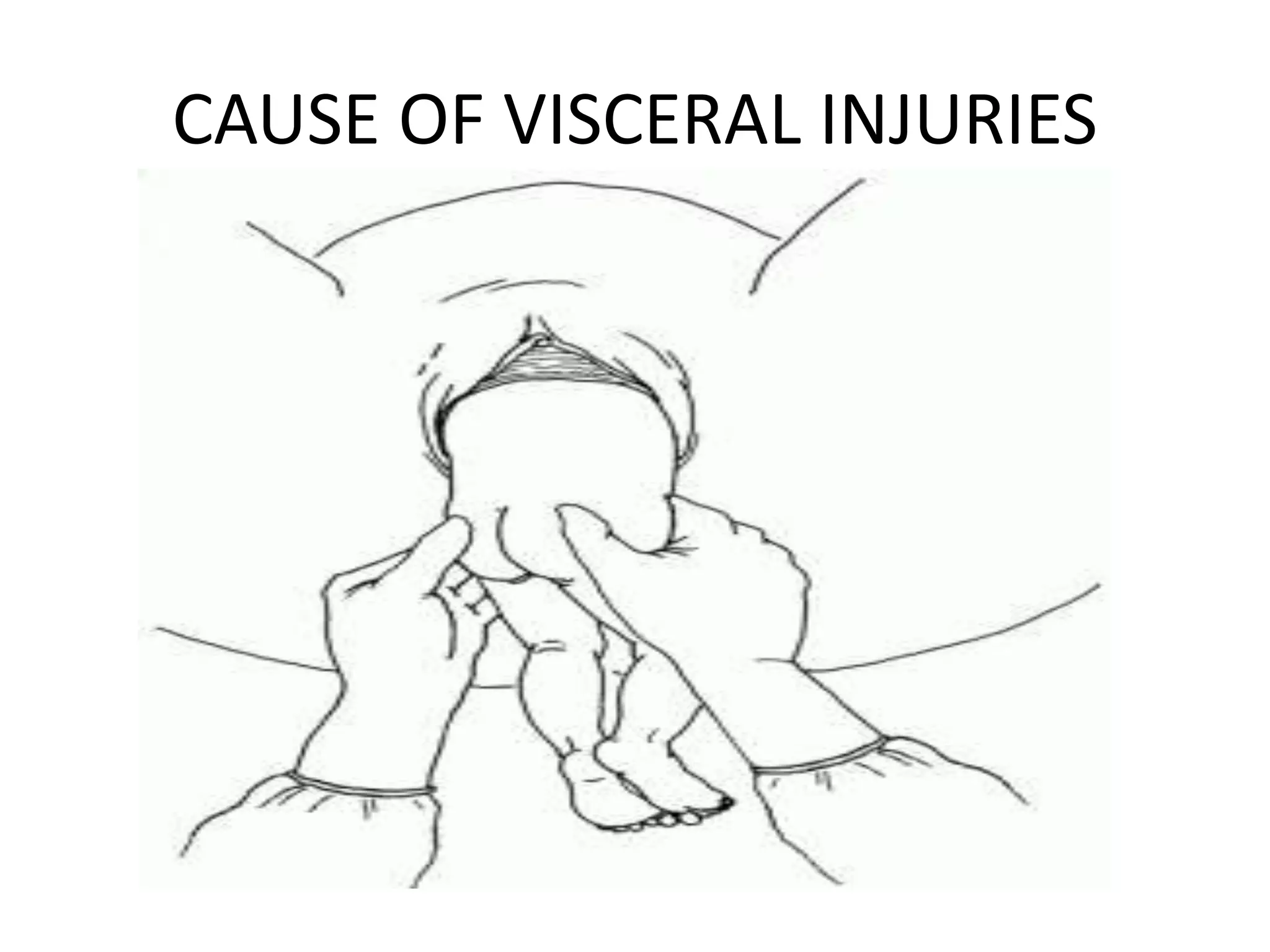 CAUSE OF VISCERAL INJURIES
 