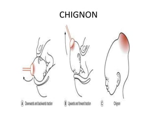 CHIGNON
 