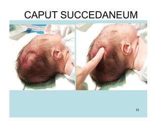 CAPUT SUCCEDANEUM
 