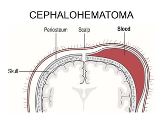 CEPHALOHEMATOMA
 