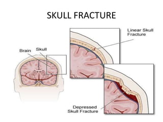 SKULL FRACTURE
 
