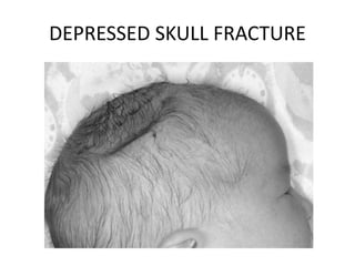 DEPRESSED SKULL FRACTURE
 