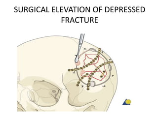 SURGICAL ELEVATION OF DEPRESSED
FRACTURE
 