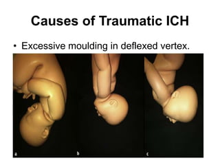 Causes of Traumatic ICH
• Excessive moulding in deflexed vertex.
 