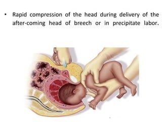 • Rapid compression of the head during delivery of the
after-coming head of breech or in precipitate labor.
 