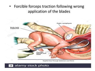 • Forcible forceps traction following wrong
application of the blades
 